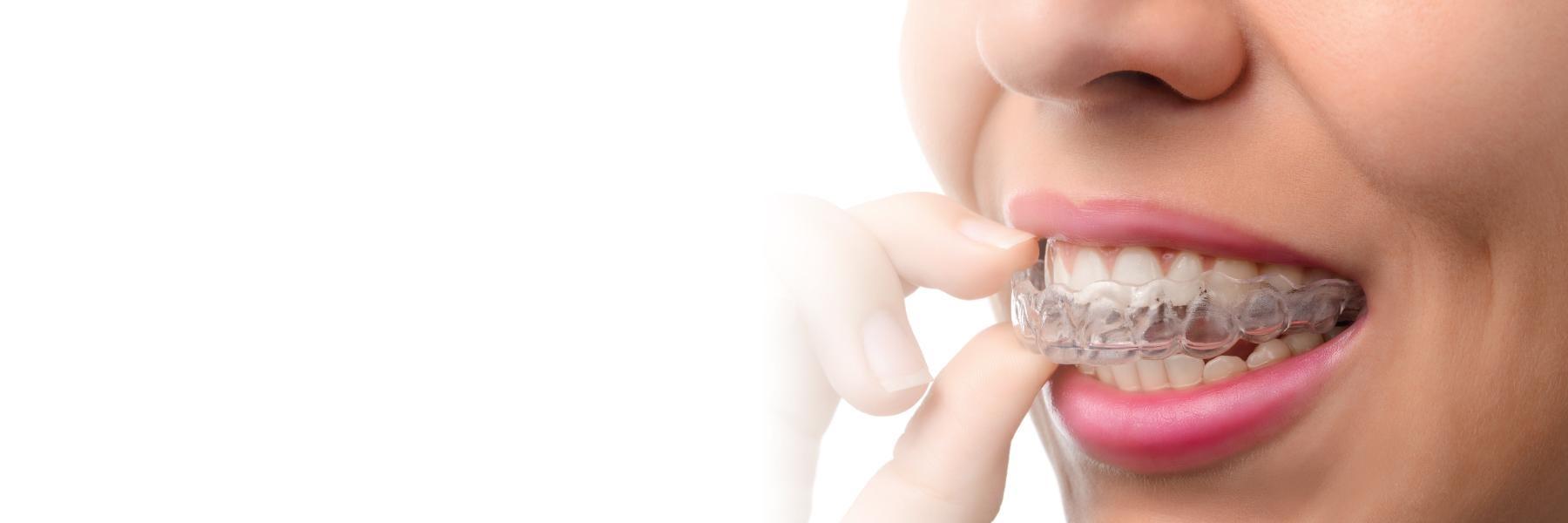 Invisalign Clear Aligners | Dentist