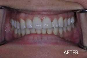 Invisalign Invisible Braces Before & After Photos