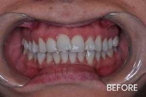 Invisalign Invisible Braces Before & After Photos